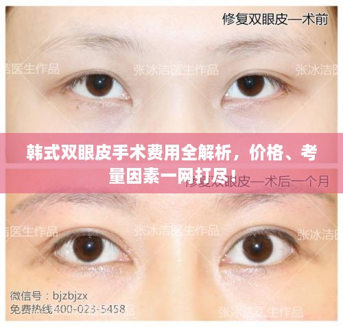韓式雙眼皮手術(shù)費(fèi)用全解析，價格、考量因素一網(wǎng)打盡！