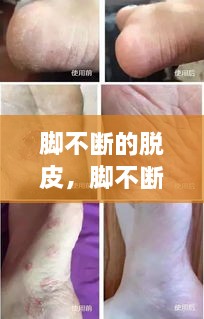 腳不斷的脫皮，腳不斷脫皮還癢 