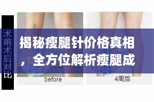 揭秘瘦腿針價(jià)格真相，全方位解析瘦腿成本！