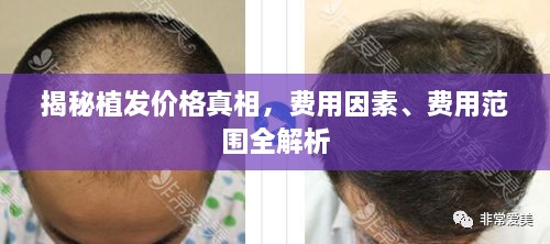 揭秘植發(fā)價格真相，費用因素、費用范圍全解析