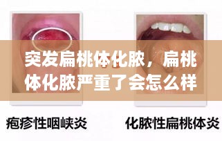 突發(fā)扁桃體化膿，扁桃體化膿嚴(yán)重了會(huì)怎么樣了 