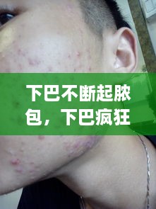 下巴不斷起膿包，下巴瘋狂長膿包 